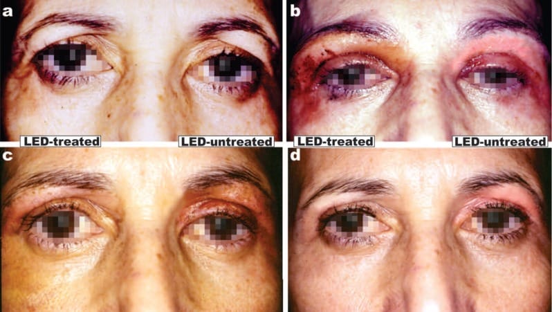 Upper and lower blepharoplasty and periocular resurfacing in a 48-year-old female. a: Baseline findings. Surgery and laser treatment (combined Er:YAG/CO2 laser) was performed bilaterally, but only the right side was treated postoperatively with LED-LLLT. b: 72 hr post-operative findings (2 LED sessions. Omnilux system, 633 nm, 126 J/cm2). The LED-treated side at first glance appears worse than the untreated side, but if the position of the upper eyelids is noted vis-à-vis the pupils, the left eye is more swollen than the right: this is LED-LLLT speeding up and then peaking inflammation on the irradiated side. c: Two weeks postop, and after a further 3 LED sessions the right side is looking much better than the left, more or less normal. d: At 2 weeks after the 8th and final treatment, 6 weeks post-baseline, there is not much difference between the two sides although slight erythema still exists on the left (LED unirradiated) eyelid. (Photography and data courtesy of Mario A Trelles MD PhD, Cambrils, Spain)