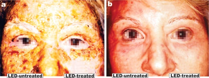 Full face ablative resurfacing in a 68-year-old female with a split-face comparison of LED-treated and untreated sides. Following full face laser ablation, the left side of the face was treated with 830 nm LED-LLLT (Omnilux, 60 J/cm2) and the right side was covered as an unirradiated control. a: 72 hours after treatment, crusting and oozing are seen on both sides, but on the left side a clear area of reepithelization can be seen on the check with some islands on the forehead (2 LED sessions delivered). None is seen on the LED-unirradiated side. b: At 6 weeks postirradiation and 3 weeks after the 7th and final LED session, the right side is still erythematous and some crusting is still seen on the forehead, whereas the LED-irradiated side is fully healed with normal skin texture. (Photography and data courtesy of Mario A Trelles MD PhD, Cambrils, Spain)