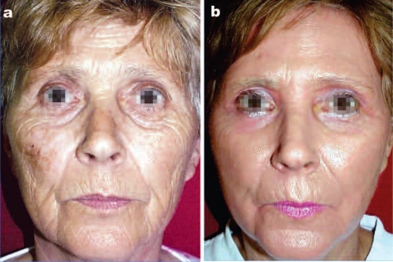 Full-face ablative laser resurfacing in a 58-year old female plus post-procedural LED-LLLT. a: Baseline findings showing severe photoageing with dyschromia, and deep lines and wrinkles due to excessive solar exposure during skiing. b: Result only 6 weeks after Er:YAG/CO2 laser ablation followed by 7 sessions of LED-LLLT Omnilux, 830 nm, 60 J/cm2). No erythema or edema can be seen with an excellent overall result. (Photography and data courtesy of Mario A Trelles MD PhD, Cambrils, Spain.)