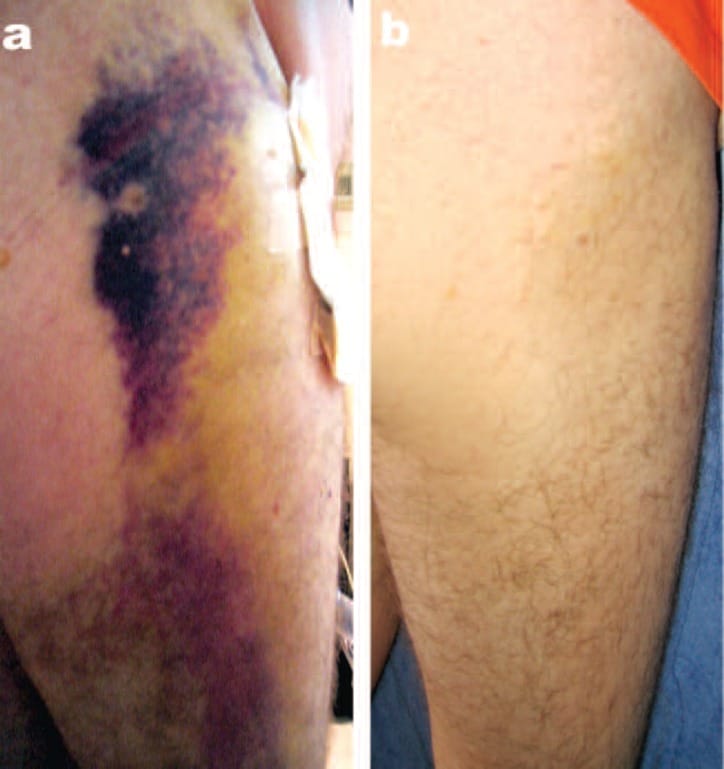 Large hematoma 2 weeks post-hip replacement before (a) and 1 week with 3 830 nm LED-LLLT sessions (Omnilux, 60 J/cm2) (b). Clinical photography courtesy of RG Calderhead PhD FRSM, South Korea