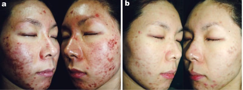 a: Treatment-resistant irritant contact dermatitis in a 26-year-old female following an alpha hydroxy acid peel for inflammatory acne. She was in pain with a very poor quality of life and did not want to go to work. b: She was treated 3 times with 830 nm HEALITE (60 J/cm2), 3 days apart, and this is the result 10 days after baseline. (From Reference 13, used with permission of the publishers. Courtesy of WS Kim MD PhD, South Korea)