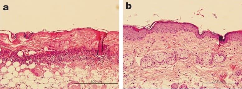 Effect of 830 nm LED-LLLT on carrageenan-induced inflammation in the rat model. (a): After induction, before LED irradiation. A severe inflammatory response has been induced with strong neutrophil infiltration seen in the dermis and inflammation-mediated disruption of the epidermal skin barrier function. (b): Immediately after 2 treatments with HEALITE 830 nm LED LLLT (60 J/cm2, 2 days apart). The inflammatory response has completely resolved, with completely normal-appearing epidermal and dermal architecture. (Hematoxylin and eosin staining, original magnification X20; scale bars as shown. Photomicrographs courtesy of WS Kim MD PhD, Seoul, South Korea)
