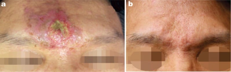 a: Ischemic ulcerative necrosis following filler placement in a 52-year-old male with infection, pain and severe inflammation. He was treated with 12 sessions of HEALITE 830 nm LLLT (60 J/cm2/session) over 5 weeks, and the figure shows the result at 1 week after the final treatment session. There is still an area of atrophy, but reepithelialization is excellent with good skin texture. (From Reference 12, used with permission of the publishers. Courtesy of PK Min MD)