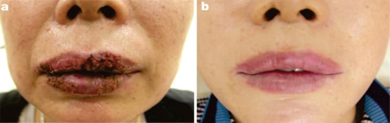 a: Baseline findings in a 54-year-old lady who attended an illegal lip tattoo parlor. She has bacterial infection, severe edema affecting almost the entire lower third of the face, pain, herpes simplex infection and slight Bell's palsy on the right side of her face. b: The excellent result after 11 HEALITE sessions over 3 weeks (60 J/cm2/session). All problems have been completely resolved, including the edema so that the lower third of the face has returned to its normal size. (From reference 12, used with permission of the publishers. Courtesy of PK Min MD)